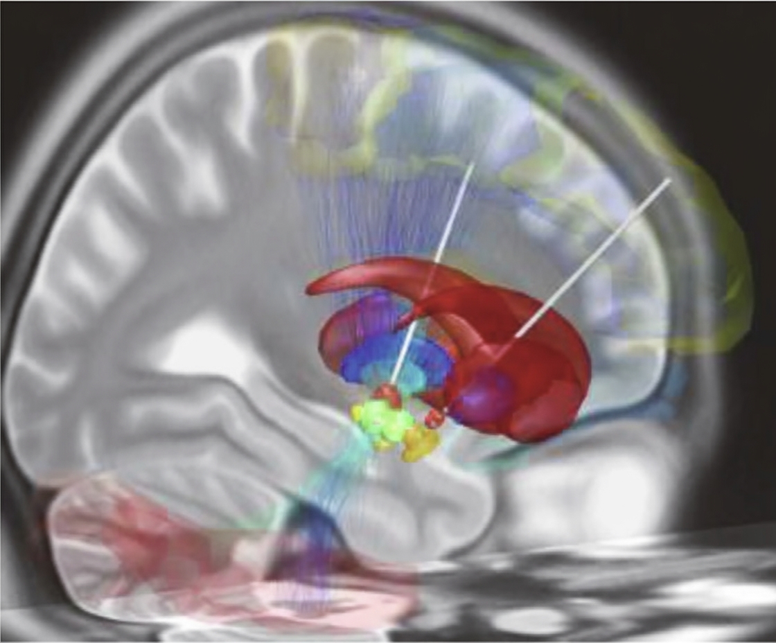 Deep brain stimulation electrodes typically used to treat Parkinson's disease. In this simulation, electrodes (white) are implanted into bilateral subthalamic nuclei (orange), brain regions that facilitate desired movements and suppress unwanted ones. Source: Wikimedia Commons (CC BY-SA 4.0).
