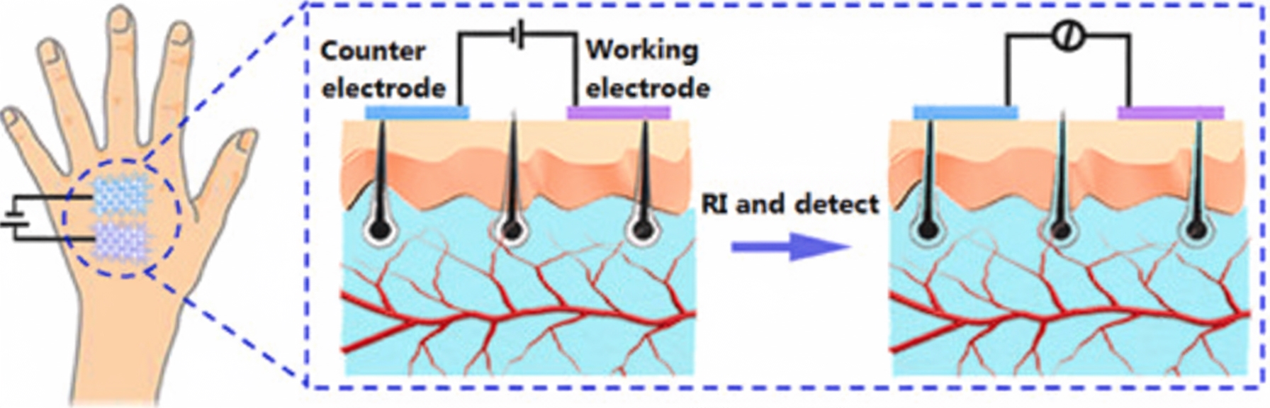 Dual-electrode flexible wearable noninvasive glucose sensor based on reverse iontophoresis (RI)