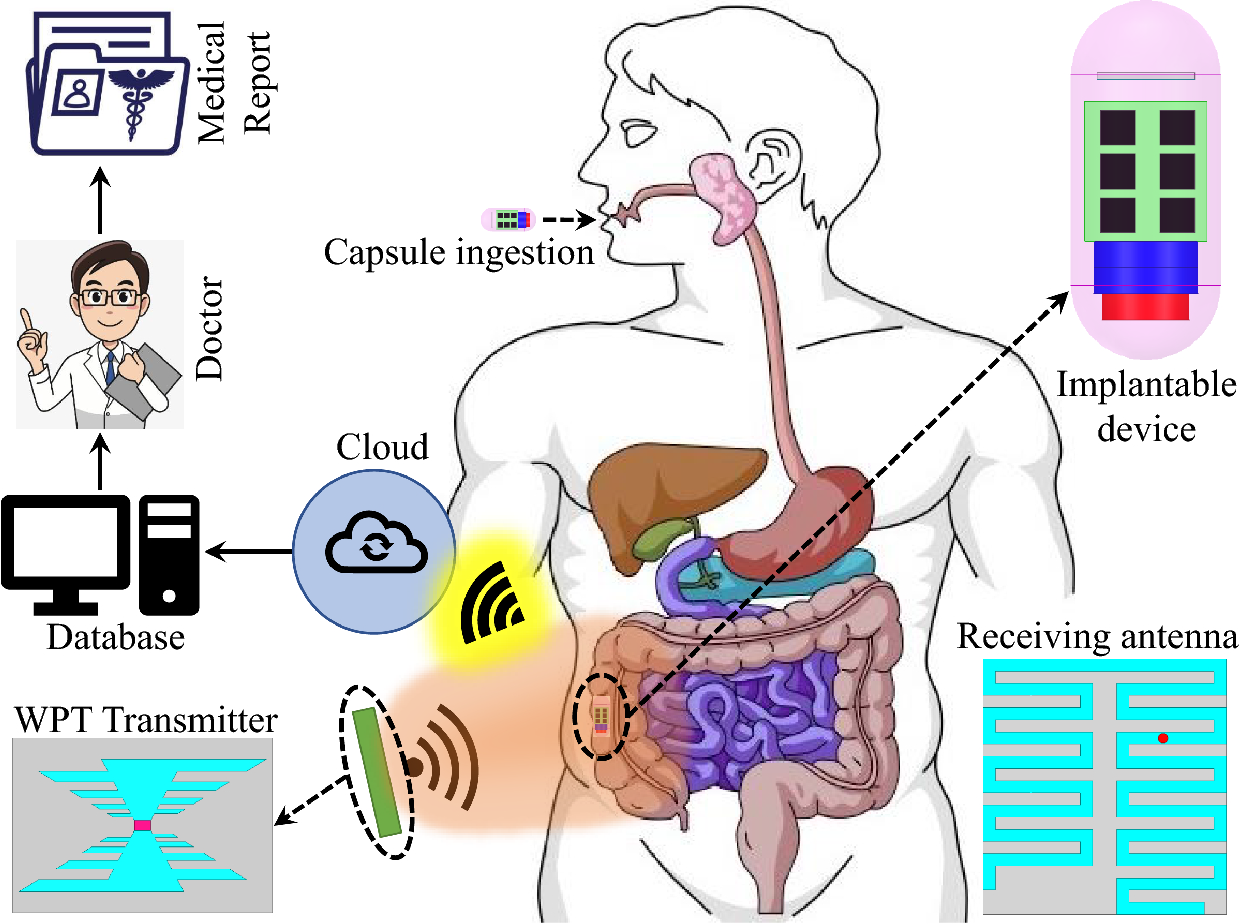 External Wireless Power for Implantable Medical Devices