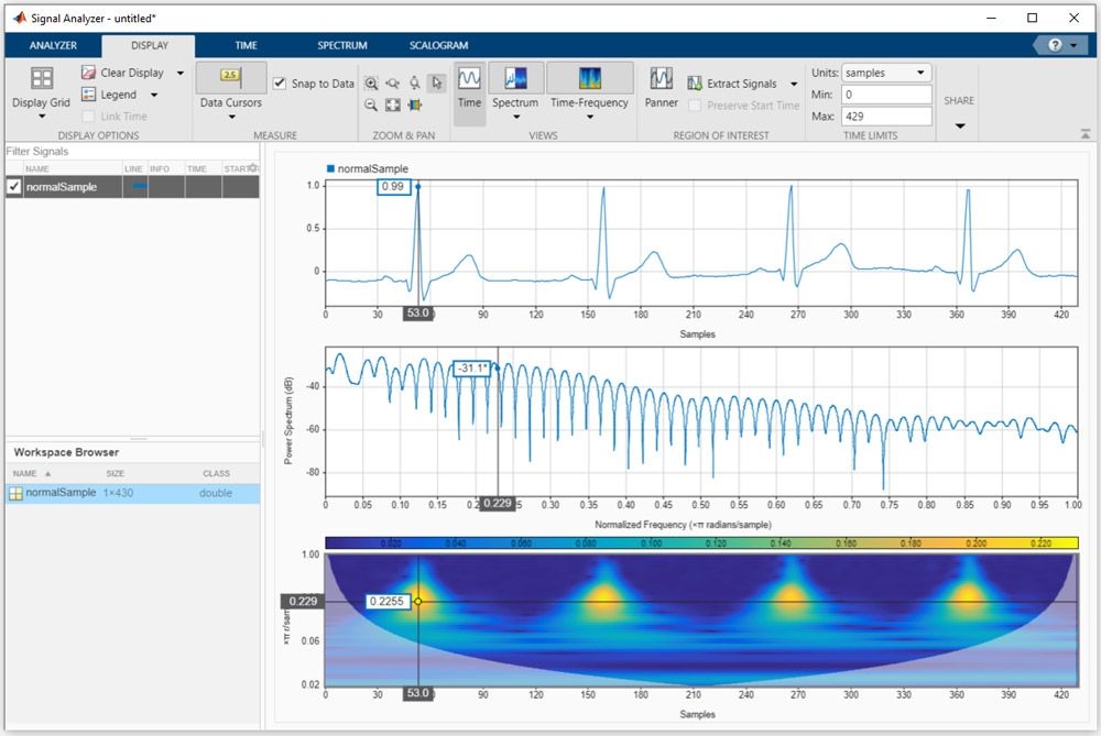 MATLAB, Signal Processing and ML Advances in Healthcare