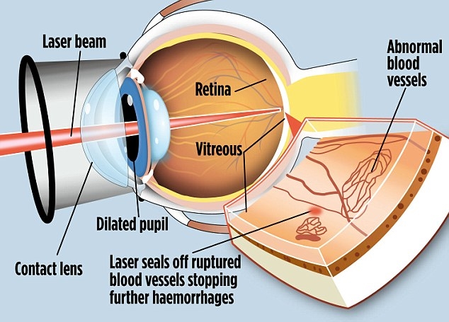 Applications and Principles of Laser in Ophthalmology