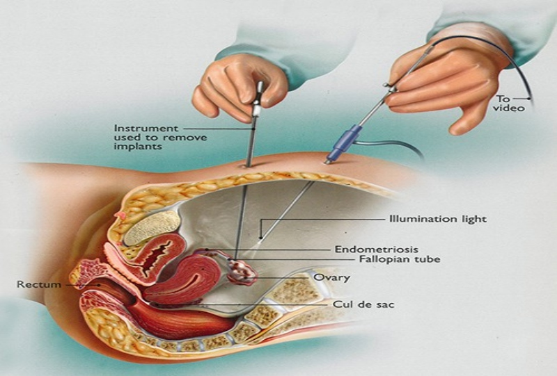 Laparoscopy in Gynecologic Diagnosis and Treatment