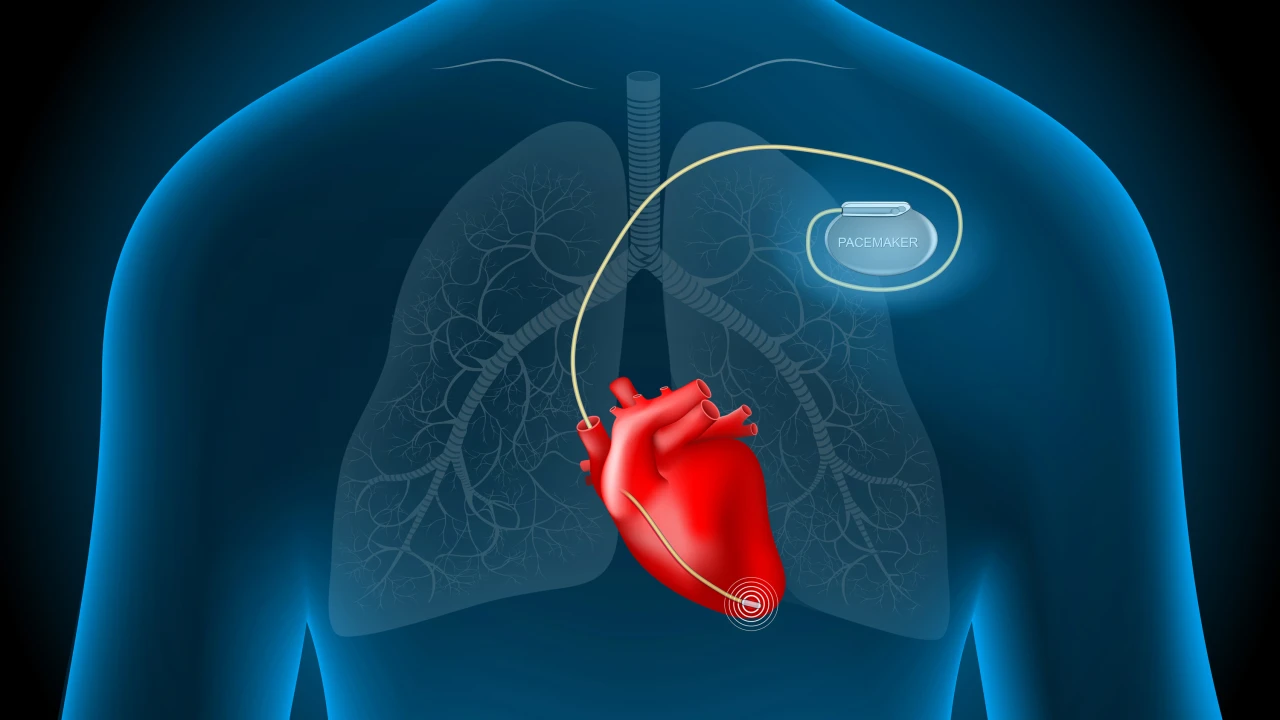 Implantable Cardiac Pacemakers: Applications and Principles