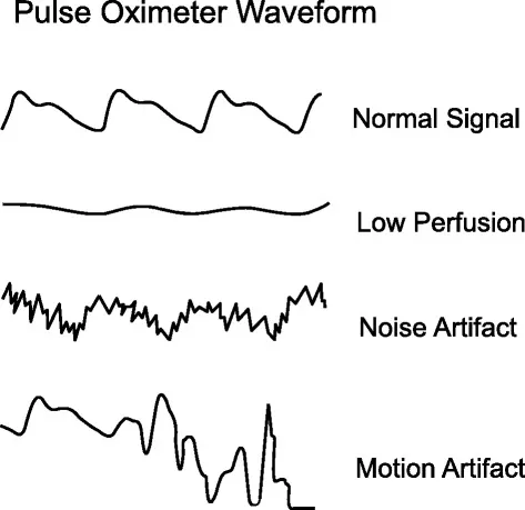 Pulse Oximeter Traces and Waveforms