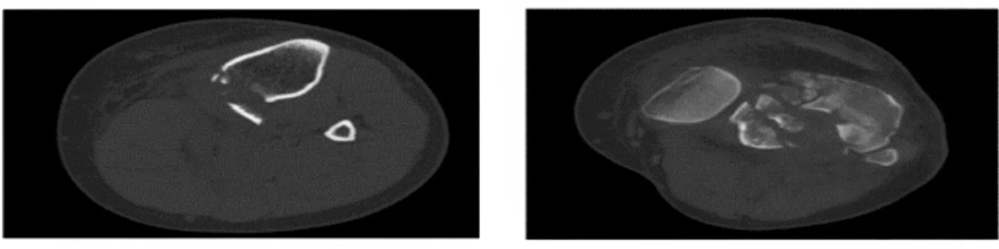 Figure 3 preoperative and postoperative CT images