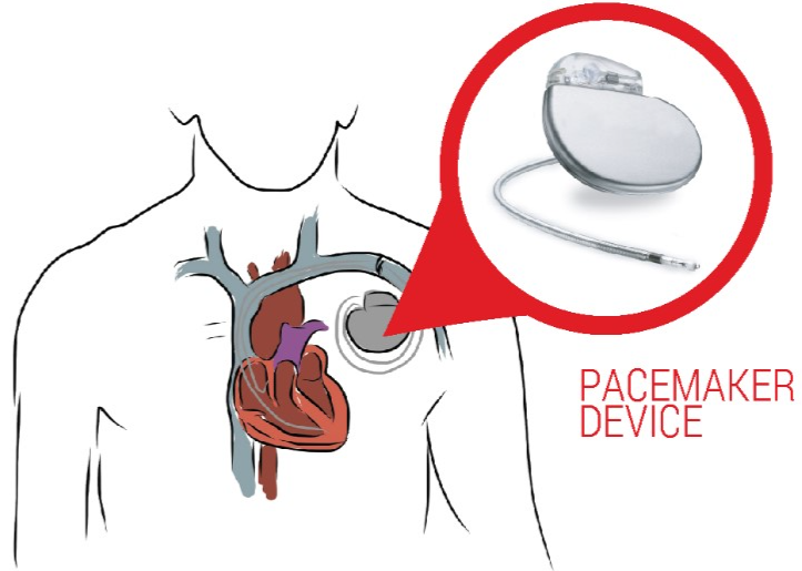 Future Trends in HDI PCB for Next-Generation Pacemakers