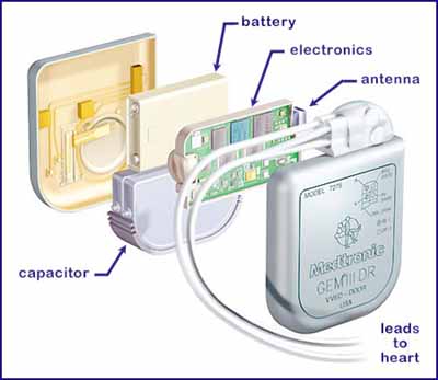 Defibrillator device with internal PCB showcasing substrate material importance